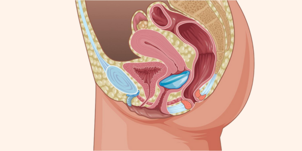 Darstellung der finalen Position der Scheibe im Muttermund